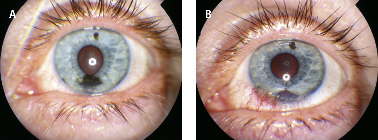    Fig. 24.7-4.  Melanoma de iris: antes  (A)  y después de la resección  (B)  (proporcionado por la Profa. Bożena Romanowska-Dixon) 