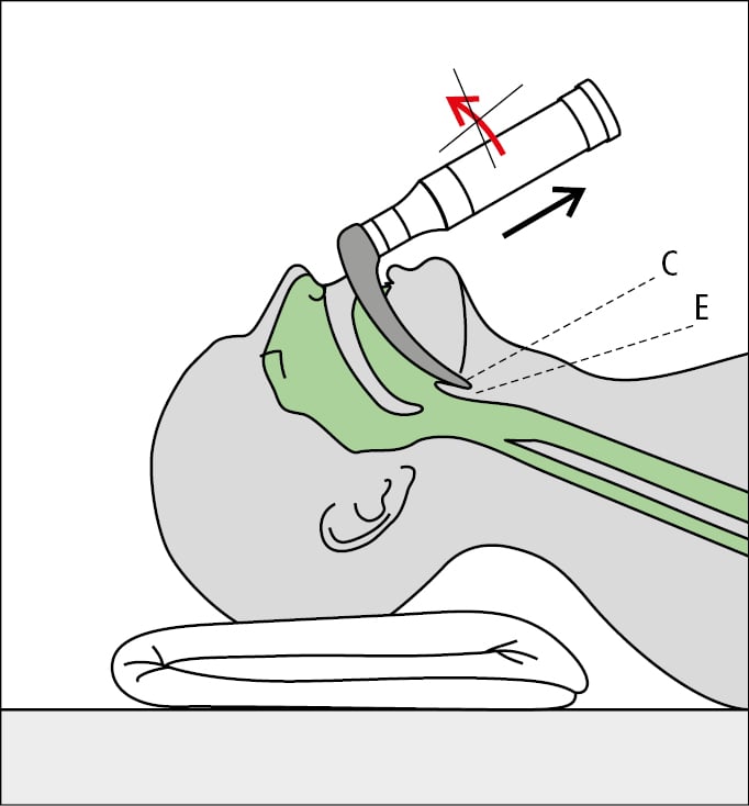    Fig. 26.19-2.  Laringoscopia directa con laringoscopio de pala curva. El extremo de la pala se introduce sobre la epiglotis (E) hasta la cavidad epiglótica (C) y la epiglotis se eleva al traccionar el laringoscopio a lo largo de su eje mayor (flecha) 