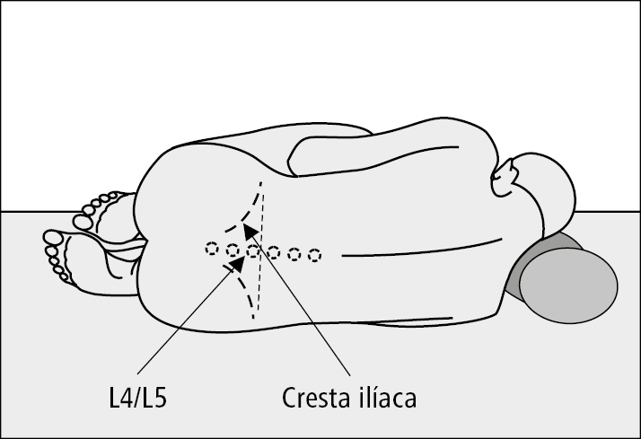    Fig. 26.13-1.  Colocación correcta del paciente durante la punción lumbar y delimitación del espacio intervertebral L4/L5 