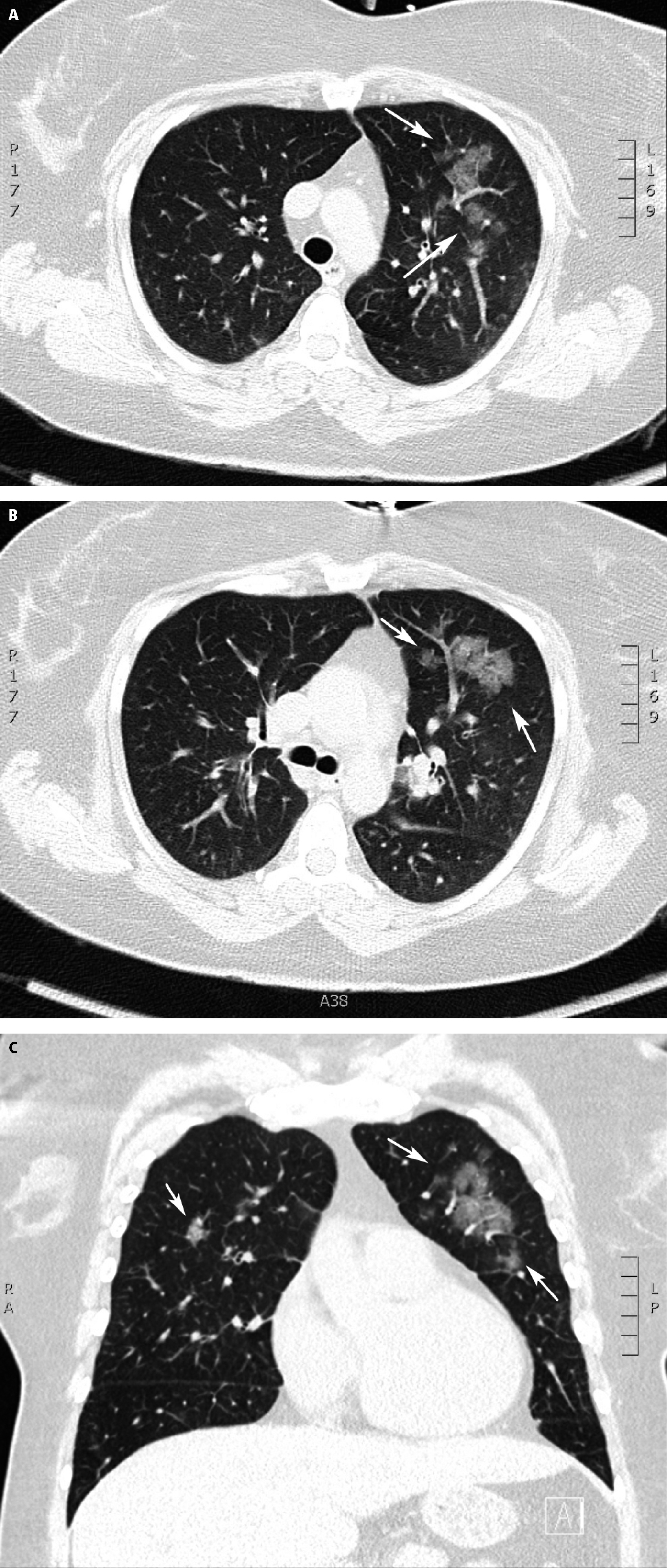  
Fig. 30.1-3.  Tomografía computarizada (TC) de una paciente de 35 años (caso n.º 1) que muestra opacidades redondeadas en vidrio esmerilado (flechas) en los planos axial  ( A, B )  y coronal  ( C )  