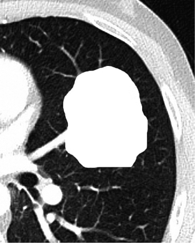  
Fig. 30.1-6.  Tomografía computarizada (TC) axial de tórax que muestra consolidación pulmonar (pulmón consolidado). Destaca que las estructuras pulmonares normales no se ven como estructuras distintas y separadas. La figura fue manipulada con un software de edición para facilitar el aprendizaje 