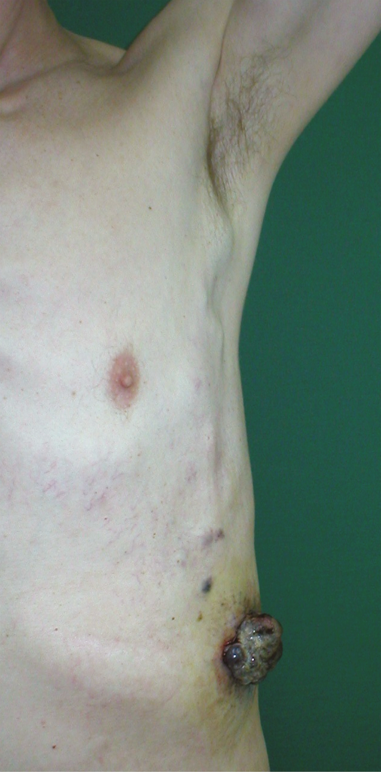    Fig. 24.7-2.  Melanoma (forma nodular): foco principal con ulceración. Un poco más arriba puede verse un nódulo perteneciente a lesiones cutáneas. En la parte inferior de la axila es visible una metástasis en un ganglio linfático que eleva la piel, mientras que, entre el foco primario y la cavidad axilar, en el tejido subcutáneo, se observan metástasis  in transit  (proporcionado por el Dr. Wojciech M. Wysocki) 