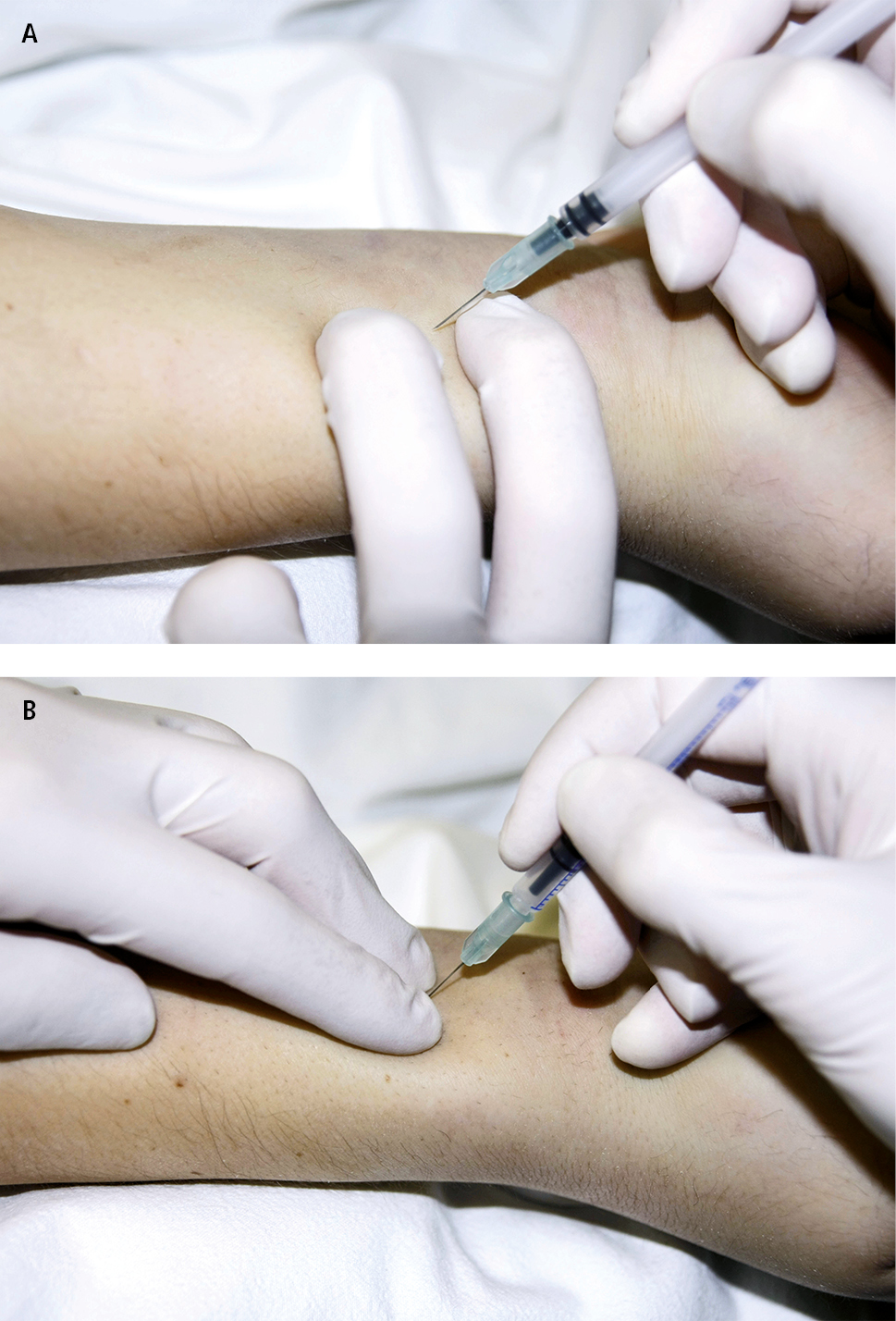 Sindromes Coronarios Agudos Sca Cardiopatia Isquemica Enfermedades Cardiovasculares Enfermedades Medicina Interna Basada En La Evidencia