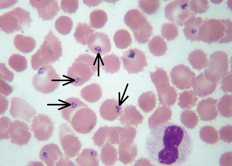    Fig. 19.4-1.  Frotis de sangre capilar de un enfermo con malaria, realizado con tinción de Giemsa. Se observa una invasión masiva de los eritrocitos por  Plasmodium falciparum.  Protozoos en estadio de anillo (flechas) (proporcionado por la Dra. Danuta Cielecka) 