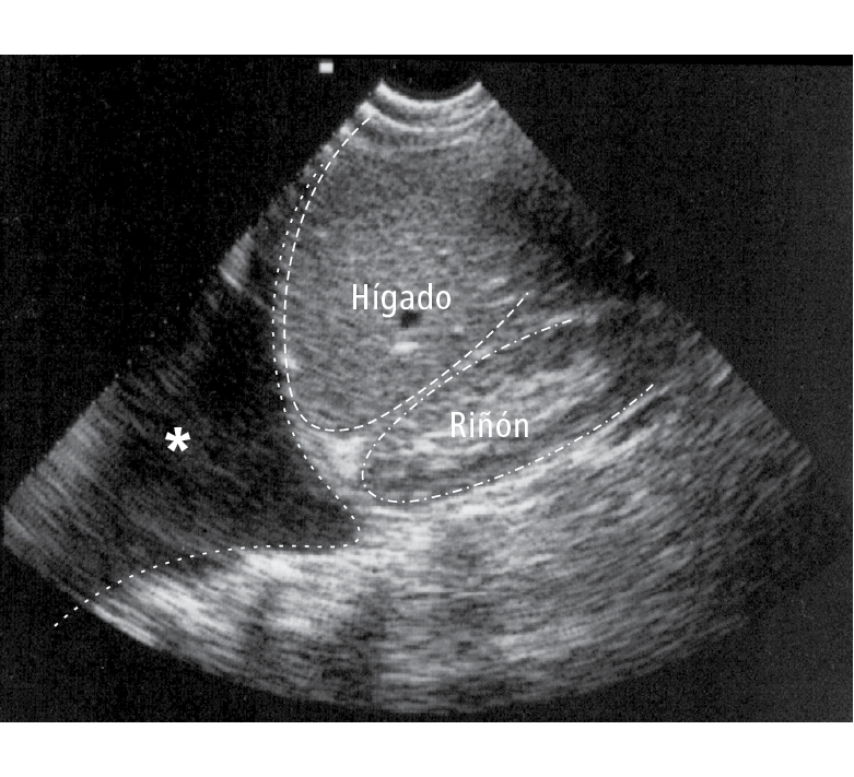  Imagen ecográfica sobre hipocondrio derecho que muestra derrame pleural (asterisco)  