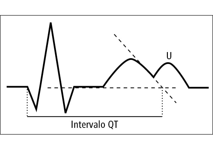  Cálculo de la duración del intervalo QT 