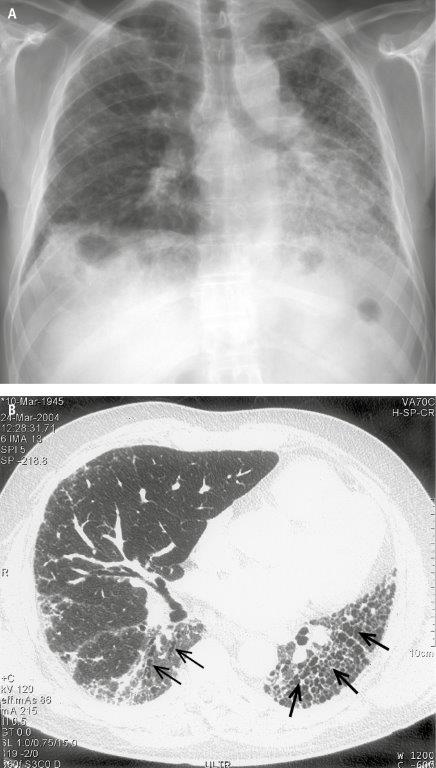  
Idiopatyczne włóknienie płuc.  A  – RTG klatki piersiowej ukazuje zmniejszoną objętość płuc oraz rozsiane zacienienia siateczkowate i linijne dominujące w przypodstawnych i obwodowych częściach płuc.  B  – w TKWR widoczne zacienienia siateczkowate, zaburzenia architektury miąższu płuc z rozstrzeniami oskrzeli z pociągania (strzałki cienkie) i torbielkami (objaw plastra miodu [strzałki grube]). Zmiany są zlokalizowane głównie podopłucnowo. 