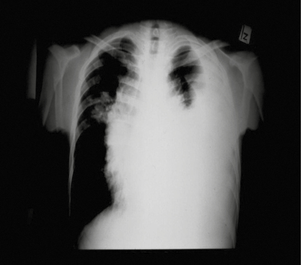  Chłoniak Hodgkina u 15-letniego chłopca. RTG klatki piersiowej – duży guz śródpiersia, przerzuty w płucach i płyn w lewej jamie opłucnowej 