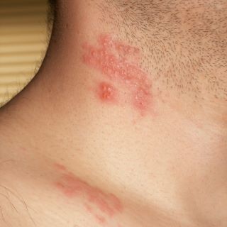 Zdjęcie pęcherzy półpaśca na szyi u&nbsp;mężczyzny