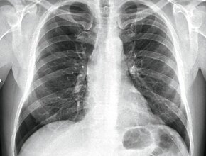 pneumonologia-54-letni-m-czyzna-z-duszno-ci-i-b-lem-w-klatce